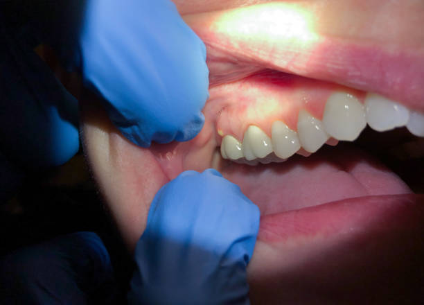 Best Urgent Tooth Repair  in Seminole, OK
